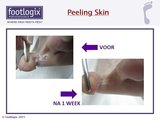 Footlogix Peeling Skin Formula Mousse 125ml_