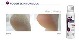 Footlogix Rough Skin Formula Mousse 125ml_